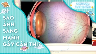 Vì sao ánh sáng mạnh gây cận thị?